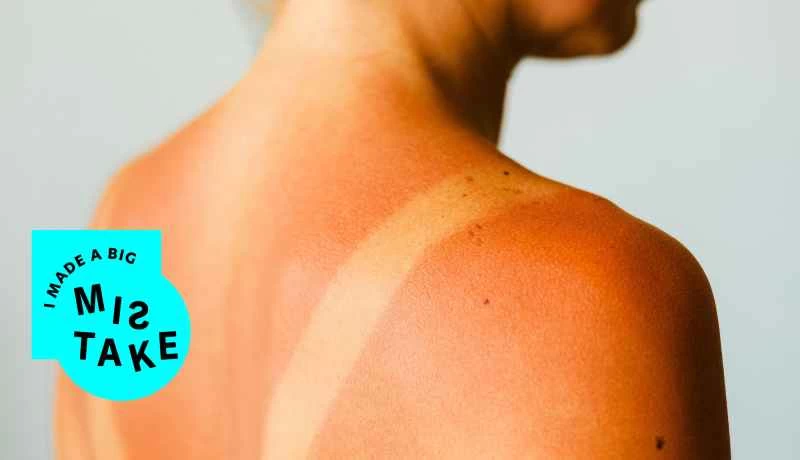 真正有效的曬傷治療方法